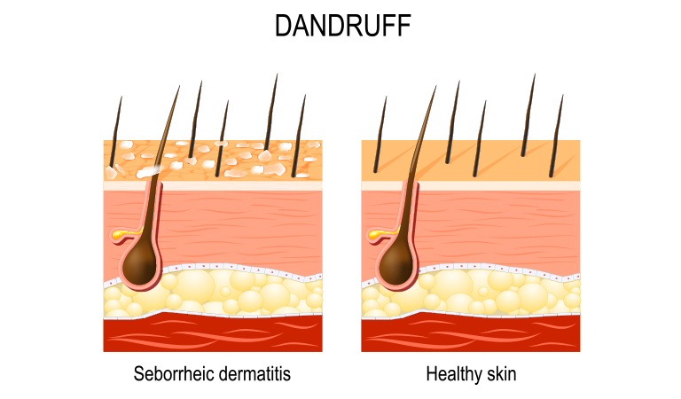 Vinegar sales for dandruff